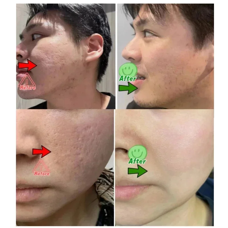 Salicylic Acid Pore Clearing C - Salicylic Acid Blackhead Remover 评论和价格