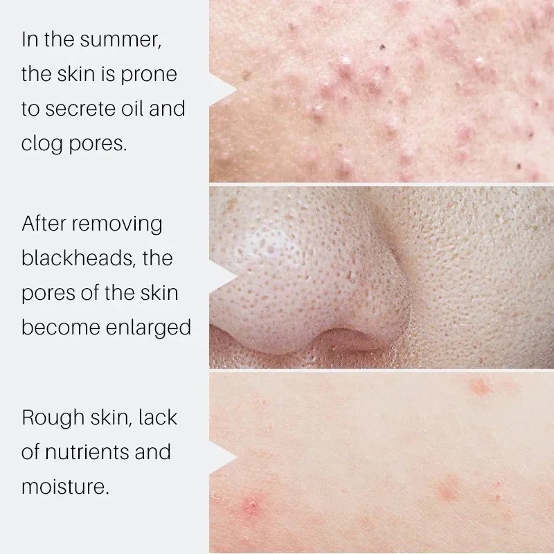 Salicylic Acid Pore Shrinking  - Salicylic Acid Blackhead Remover 评论和价格