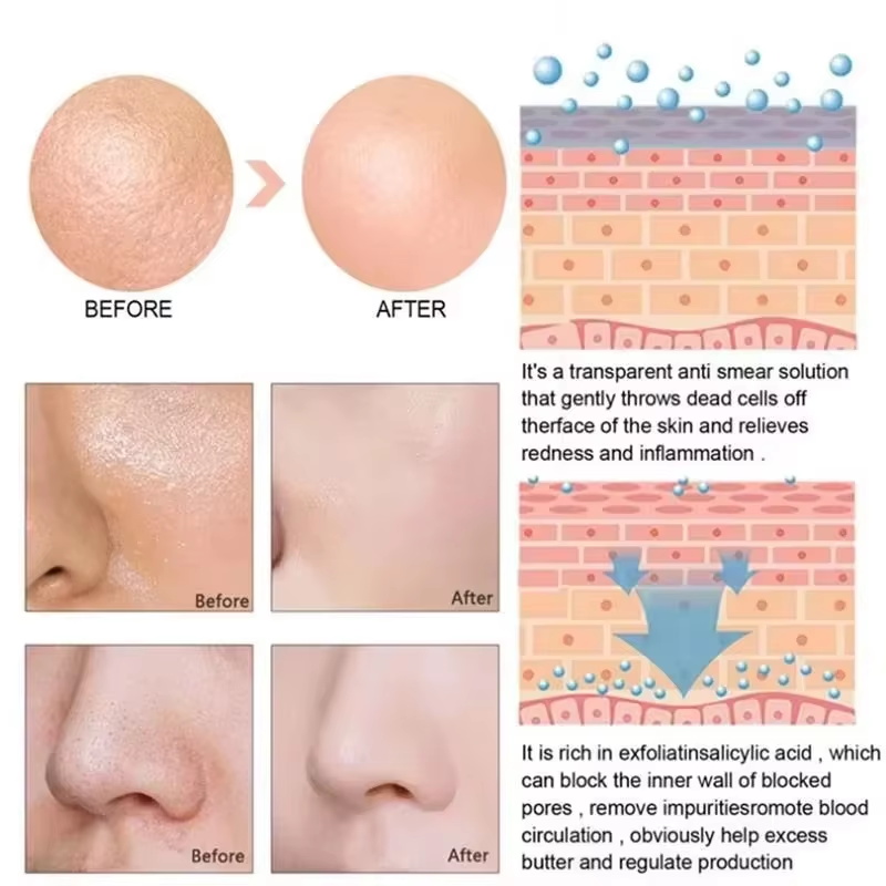 Salicylic Acid Pore Shrinking  - Salicylic Acid Blackhead Remover 评论和价格