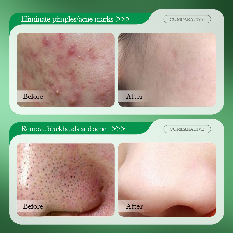Salicylic Acid Acne Treatment  - Salicylic Acid Blackhead Remover 评论和价格